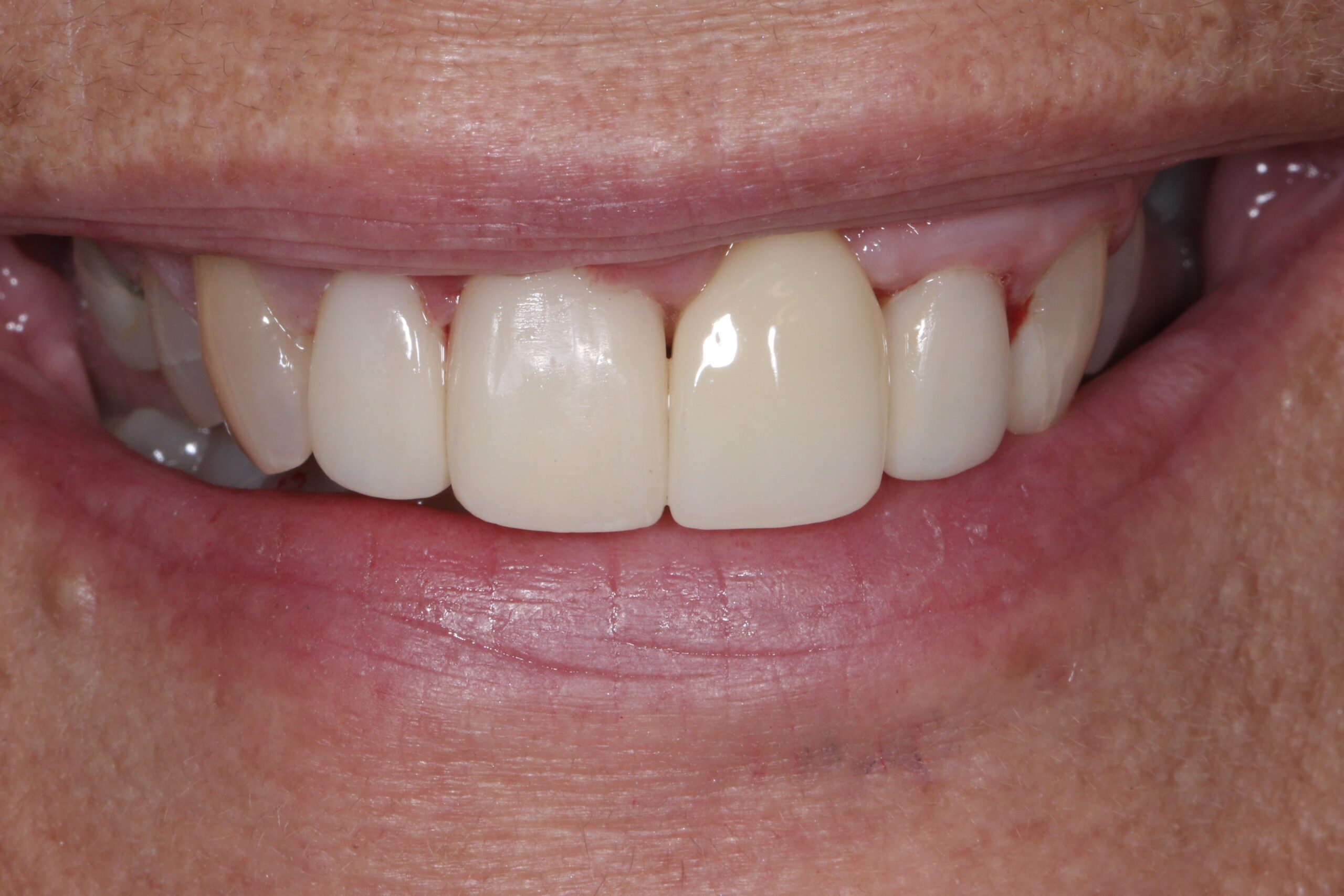 1 Implant Crown (after) (3)
