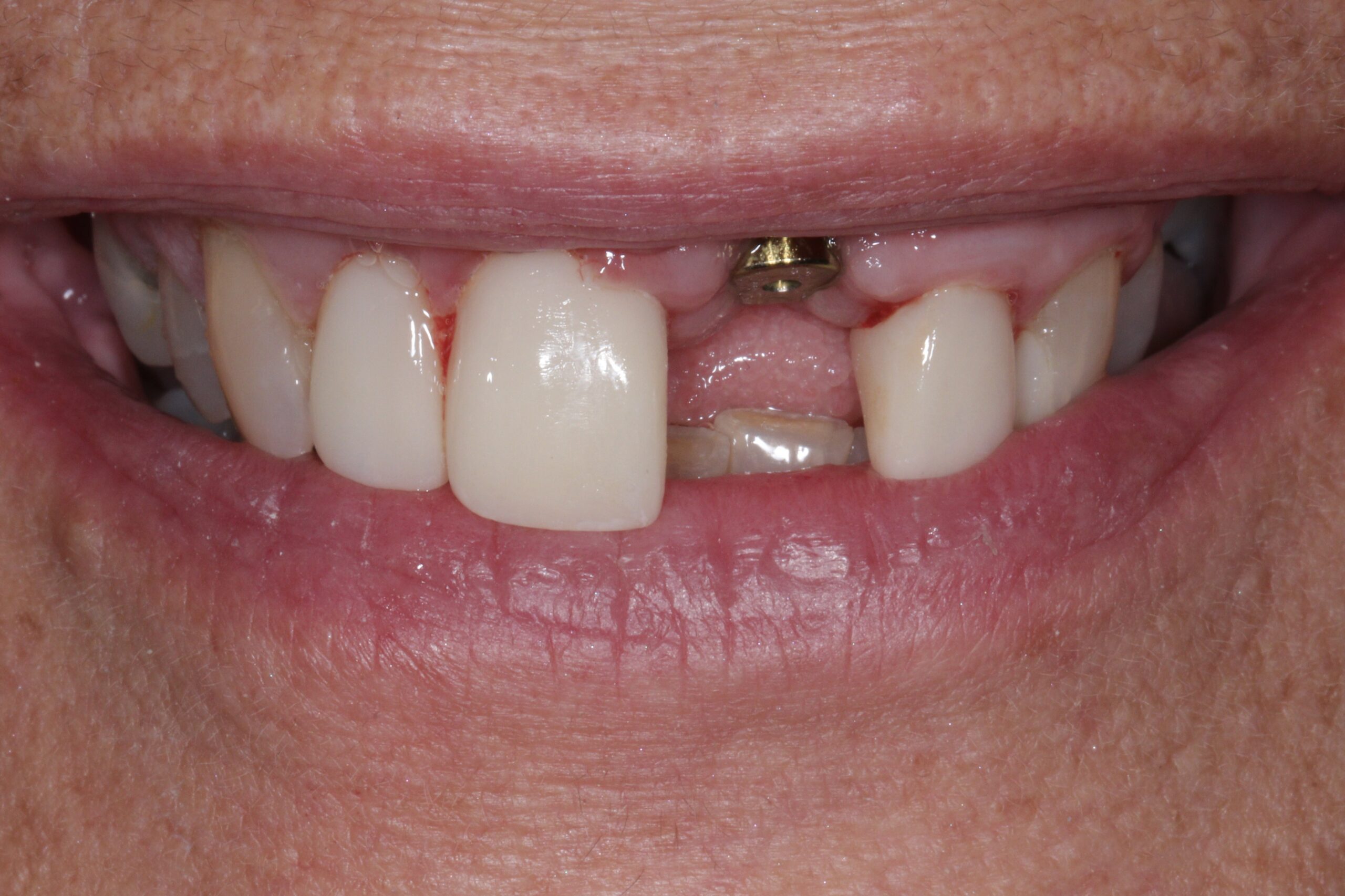 1 Implant Crown (before) (3)