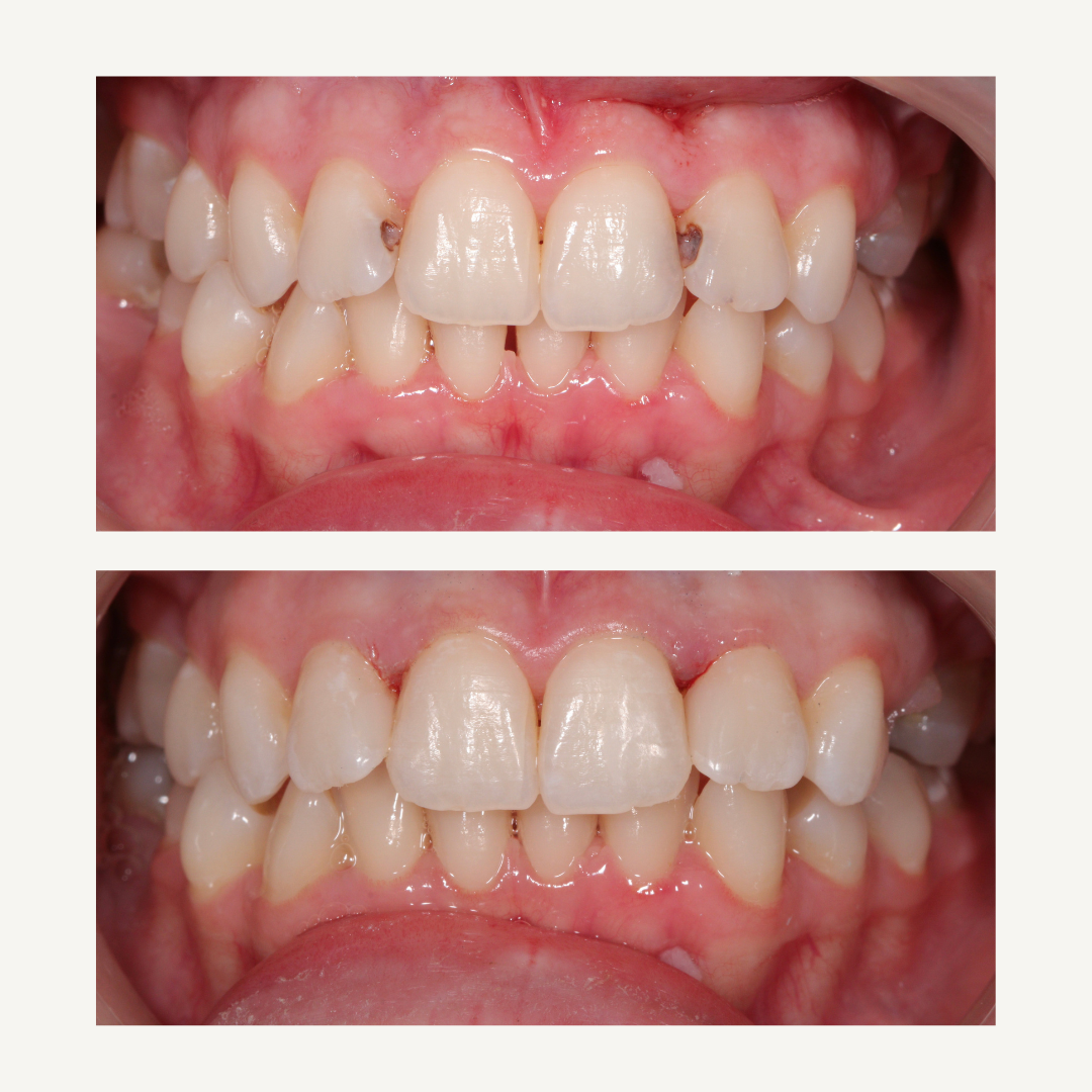 Beige Brown Neutral Before + After Instagram Post (2) Beige Brown Neutral Before + After Instagram Post (2)