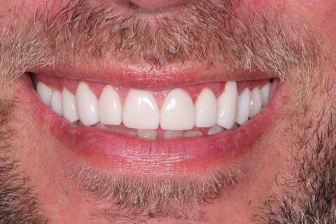 Man Smiling after his new veneers from Dr. Patel