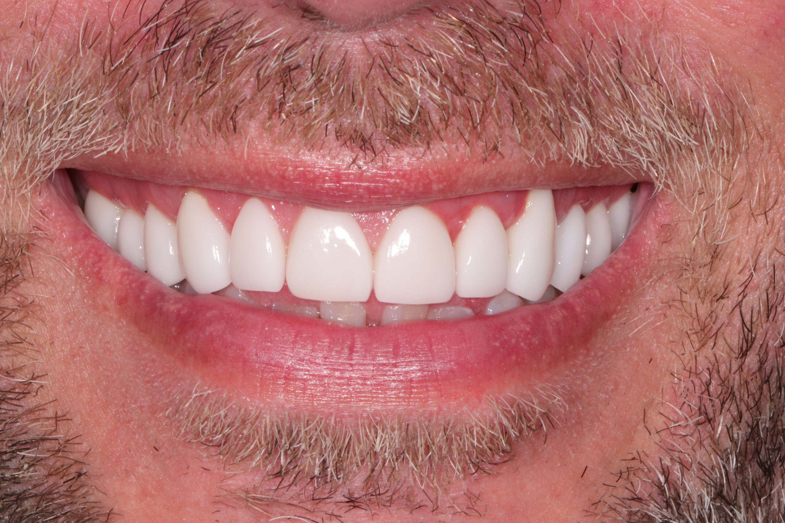 Man Smiling after his new veneers from Dr. Patel