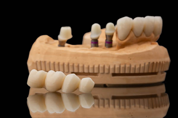 Dental Implant Restoration Cornelius, NC
